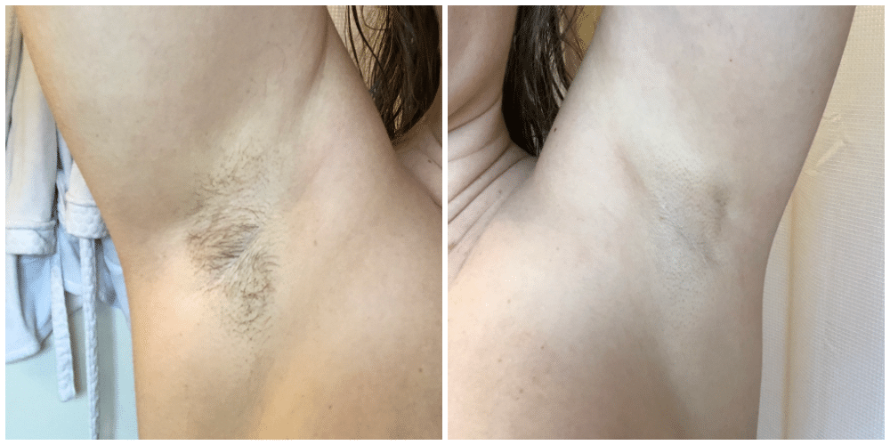 Laser Hair Removal St. Louis | Before & After Review! - Fantabulosity